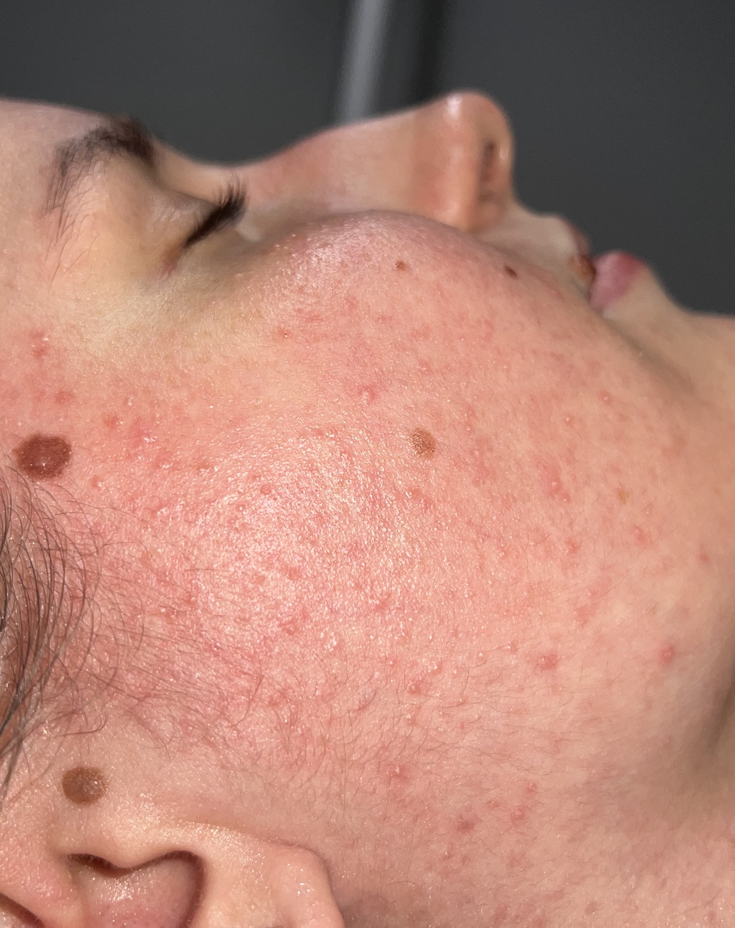 Efekt przed dwoma zabiegami PRO XN 1 stopień