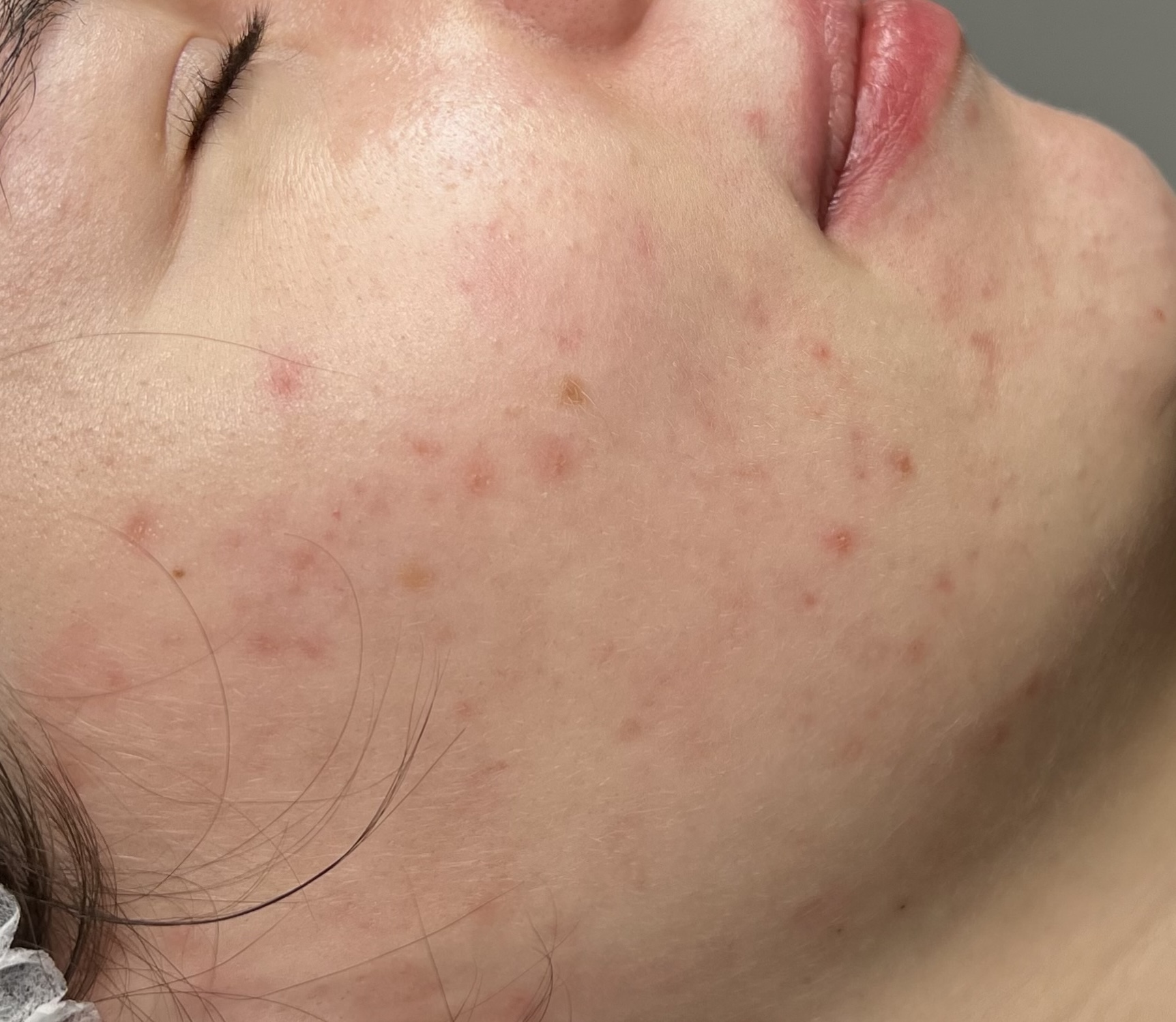 Efekt po jednym zabiegu PRO XN 1 stopień