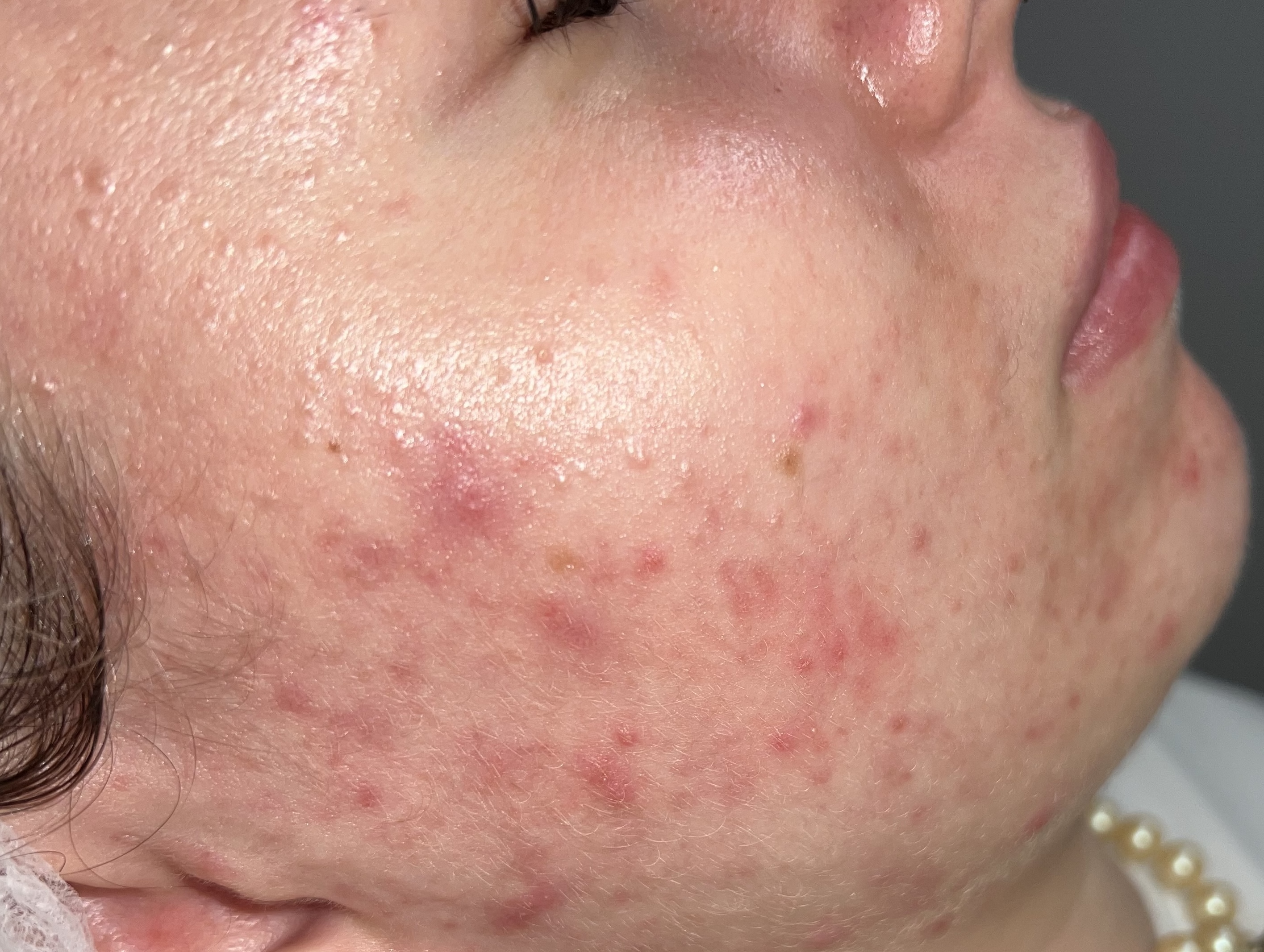 Efekt przed jednym zabiegiem PRO XN 1 stopień