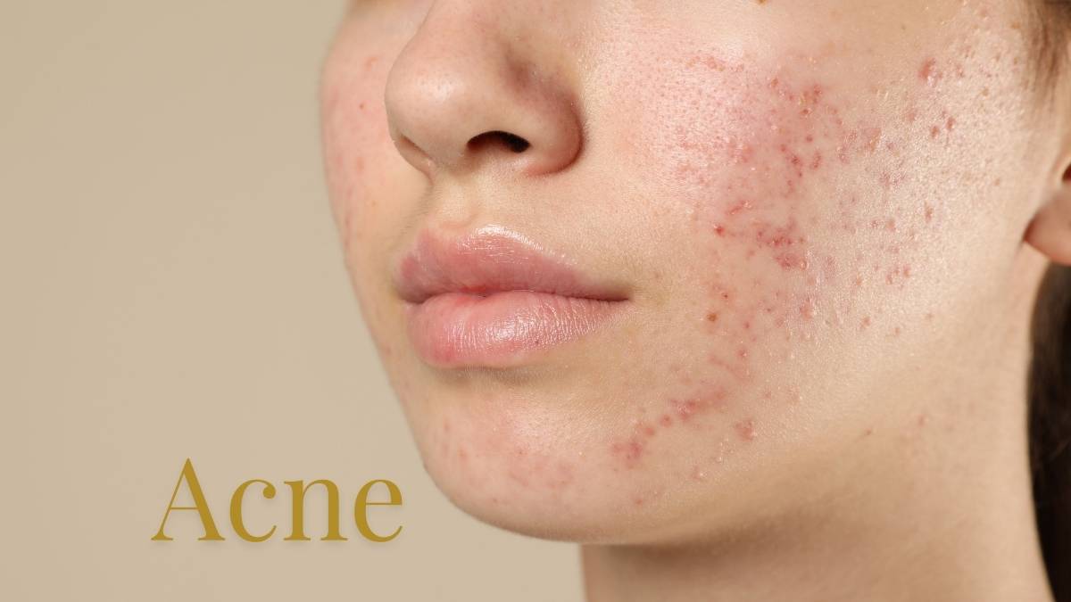 Trądzik pospolity – diagnostyka i leczenie w Krakowie (Czyżyny)